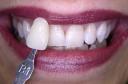 Blanqueamiento dental externo (despuÃ©s del tratamiento)