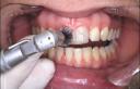 Blanqueamiento dental externo