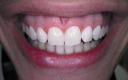 Blanqueamiento dental externo
