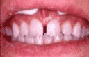 Diastema interincisivo