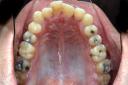 Vista oclusal superior