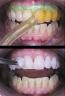 Blanqueamiento dental externo