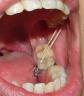 Descruce del molares
