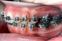Vista lateral con extraccion de 2Â° premolar